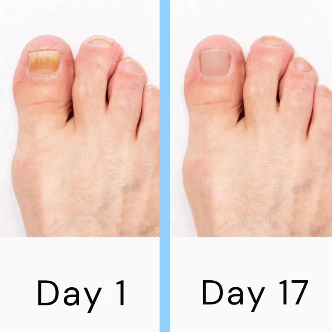 Nail Fungus Laser Treatment Device – Light Therapy for Toenail Fungus & At-Home Fungal Nail Care Solution