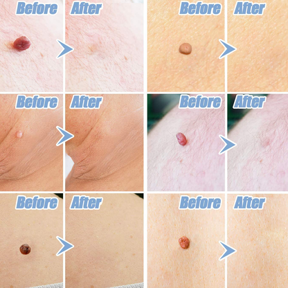 Painless Skin Tag Removal Kit for Safe At Home Skin Tag Treatment