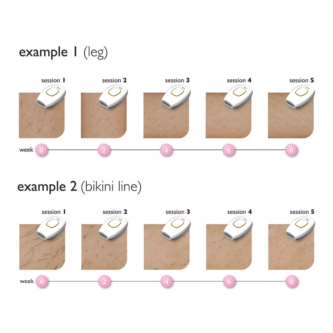 IPL Hair Removal Handset System – A Laser-Free Alternative
