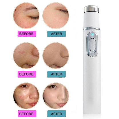 Antifungal Blue Light Laser Pen Set for Nail Fungus and Acne Treatment