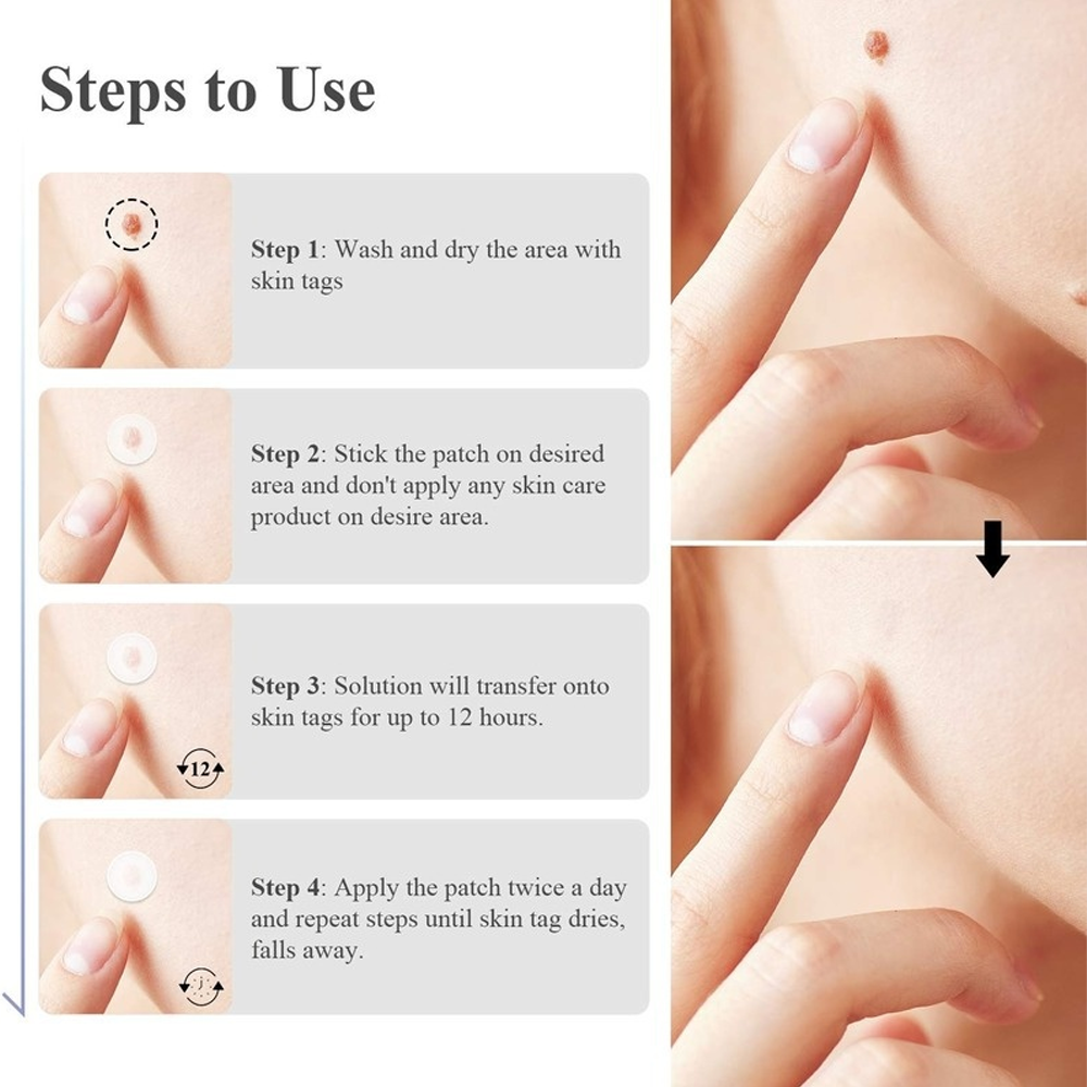 Skin Mole Removal Patch – Safe DIY Tag Remover | Perfect Skincare Gift