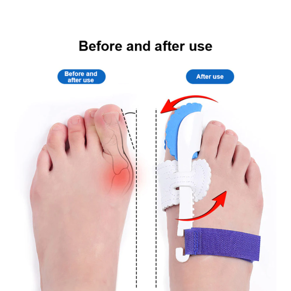 Bunion Corrector for Men & Women