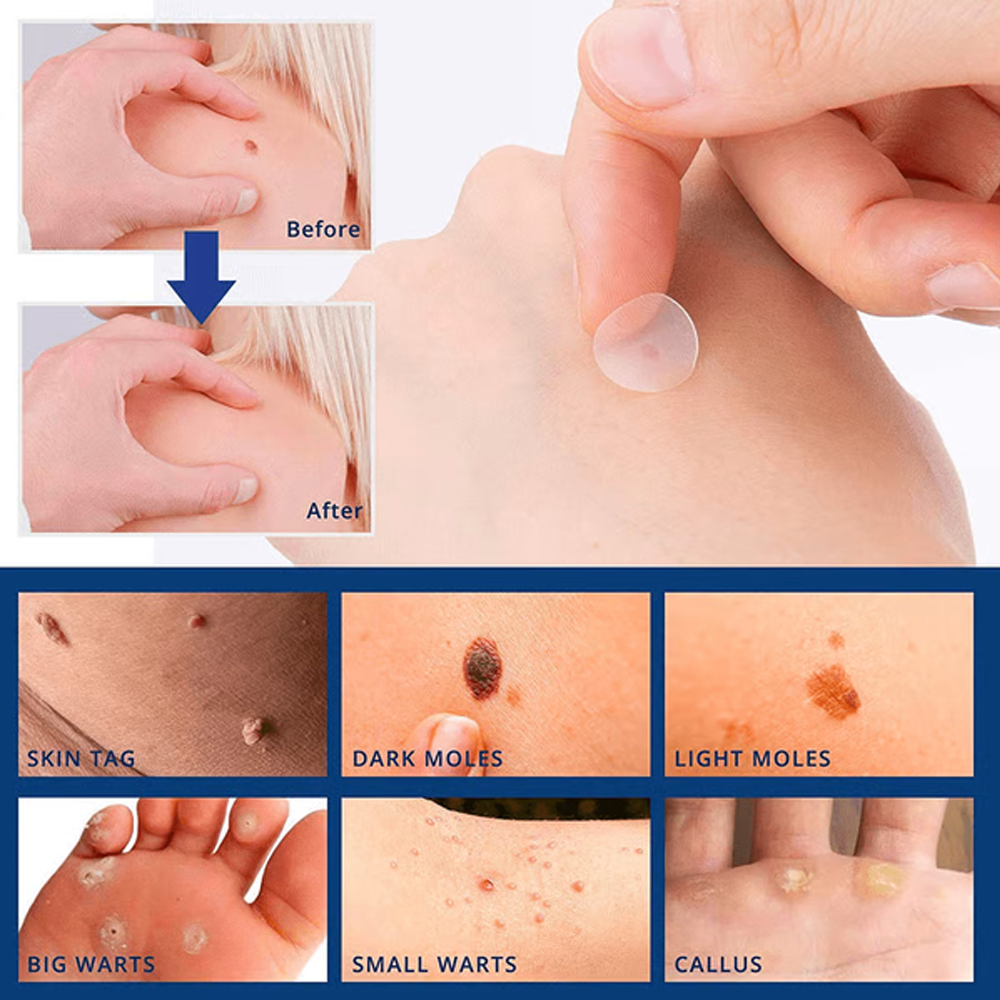 Anti Skin Tag Removal Patches – Natural Skin Tag Patches for Smooth Skin | Perfect Skincare Gift