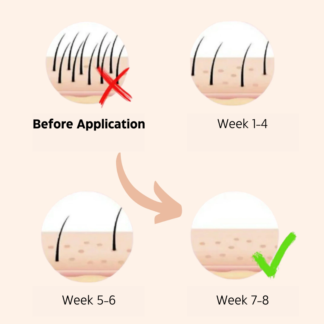 IPL Hair Removal Handset System – A Laser-Free Alternative