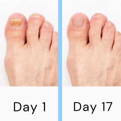 Nail Fungus Laser Treatment Device – Light Therapy for Toenail Fungus & At-Home Fungal Nail Care Solution