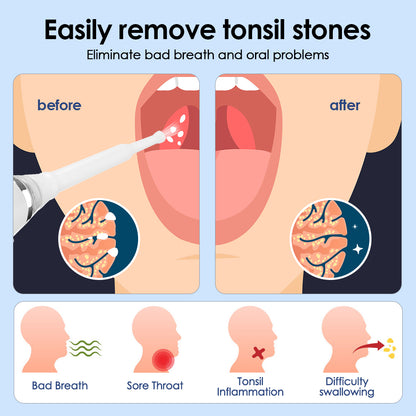 Electric Tonsil Stone Remover Kit, Tonsil Stone Removal Vacuum with LED Light, 3 Suction Modes & Irrigation Syringe...