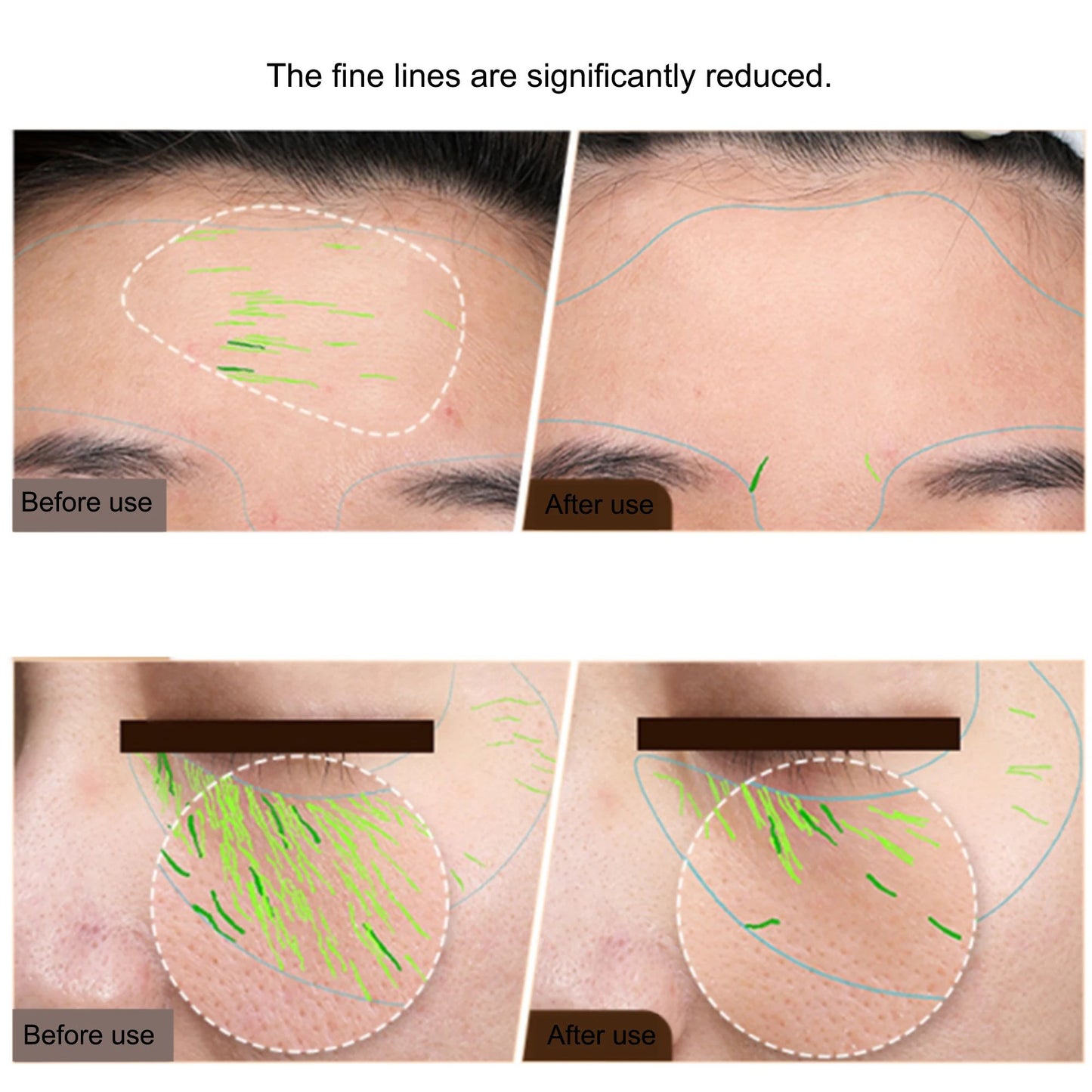 Professional RF Beauty Device EMS Skin Tightening & Face Lifting Machine