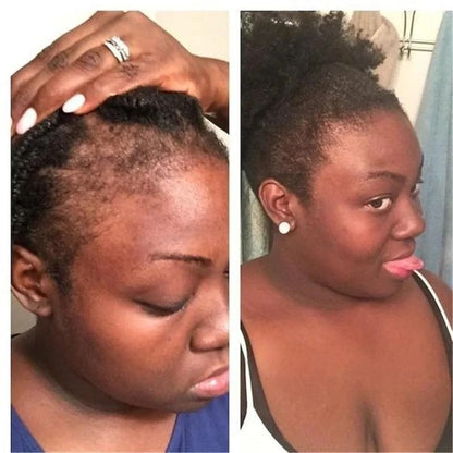 Rosemary Onion Hair Growth Shampoo with Anti-Hair Loss Spray Fast Hair Regrowth in 7 Days