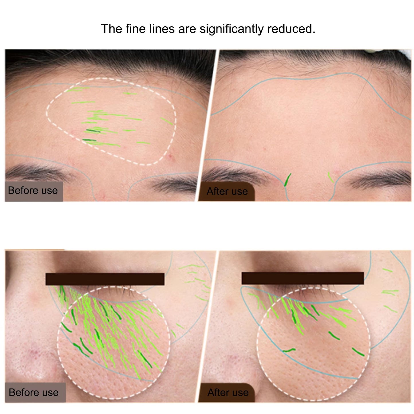 Professional EMS RF Facial and Body Skin Tightening Device – Home Radio Frequency Machine for Face Lifting, Wrinkle Redu