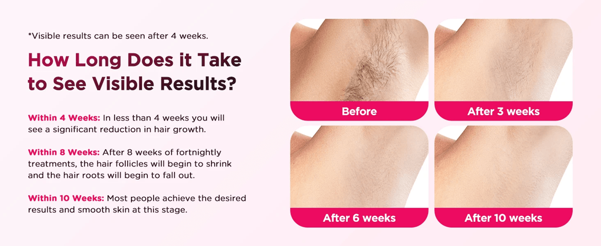 SilkBeam 990000 Flash IPL Hair Removal Device for Face and Body