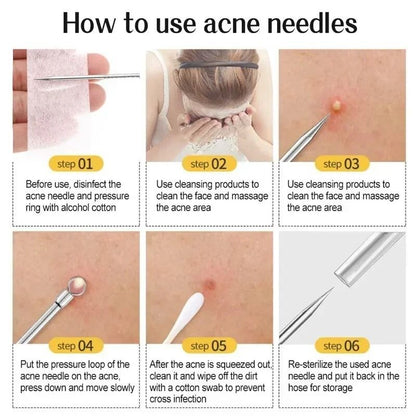 faciaAcne and Blackhead Remover Tool Set with Ultra Fine Tweezers and Extractor Needles