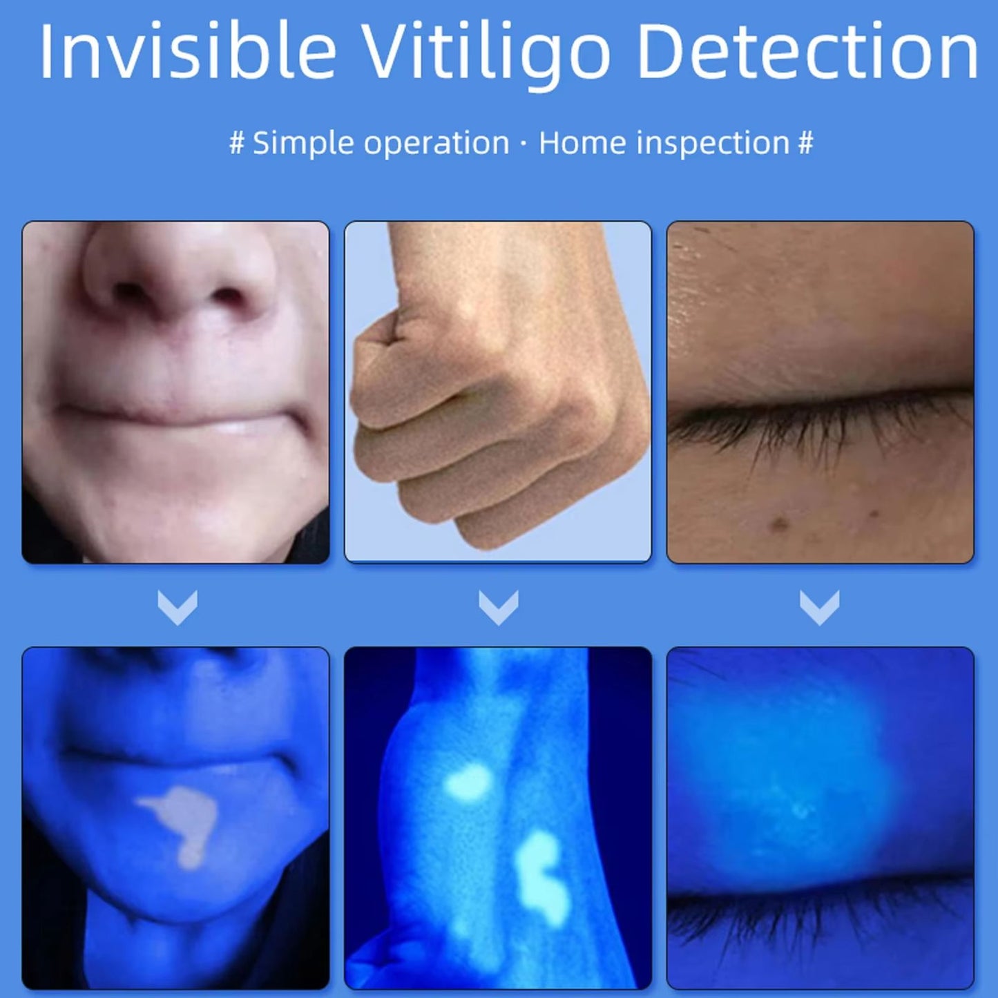 Professional Dermatoscope Skin Medical Magnifier with Wood's Lamp UVA Light for Vitiligo and Skin Analysis