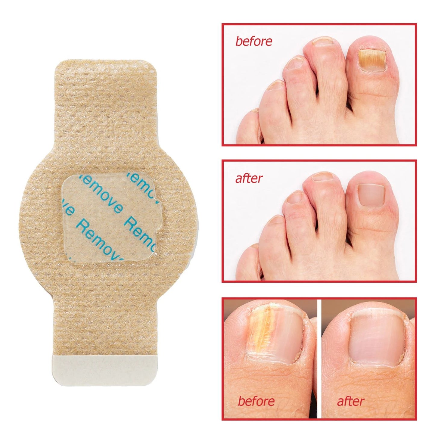 Fast-Acting Toenail Fungus Treatment Patches for Nail Discoloration & Brittle, Peeling, Breaking Thin Nails Repair