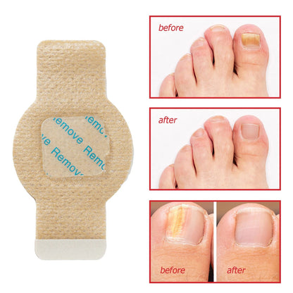 Fast-Acting Toenail Fungus Treatment Patches for Nail Discoloration & Brittle, Peeling, Breaking Thin Nails Repair
