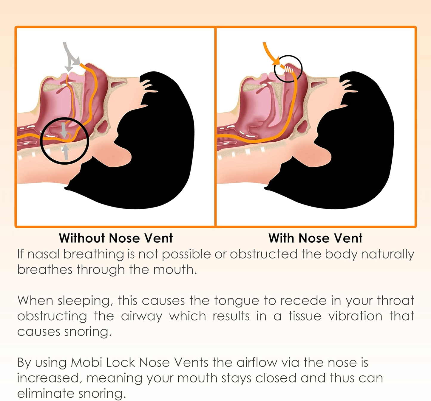 Anti Snore Nose Clip Set, Comfortable Nasal Dilators for Snoring & Sleep Apnea Relief