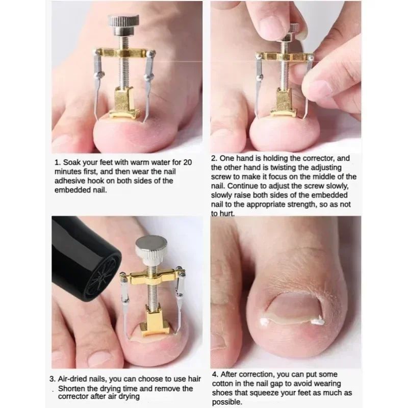 Professional Ingrown Toenail Corrector Kit Stainless Steel Toenail Repair & Relief Tool