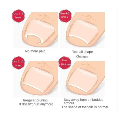 Professional Ingrown Toenail Corrector Kit Stainless Steel Toenail Repair & Relief Tool