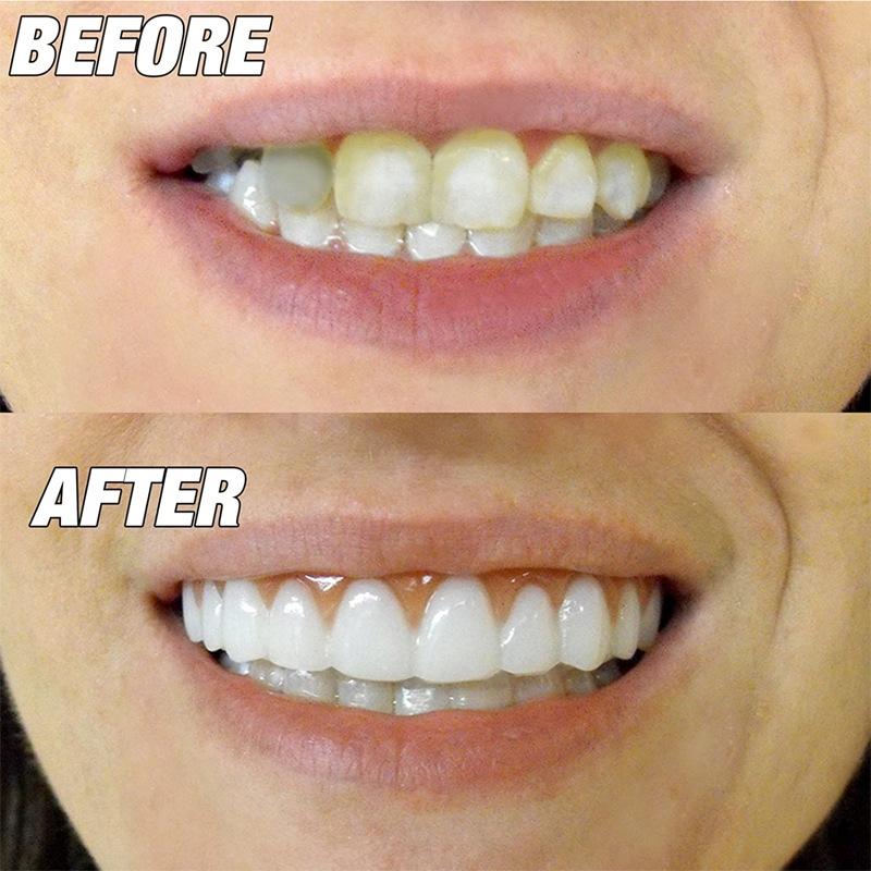 Natural Fit Instant Smile Teeth Cover Temporary Snap On Veneer