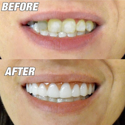 Natural Fit Instant Smile Teeth Cover Temporary Snap On Veneer