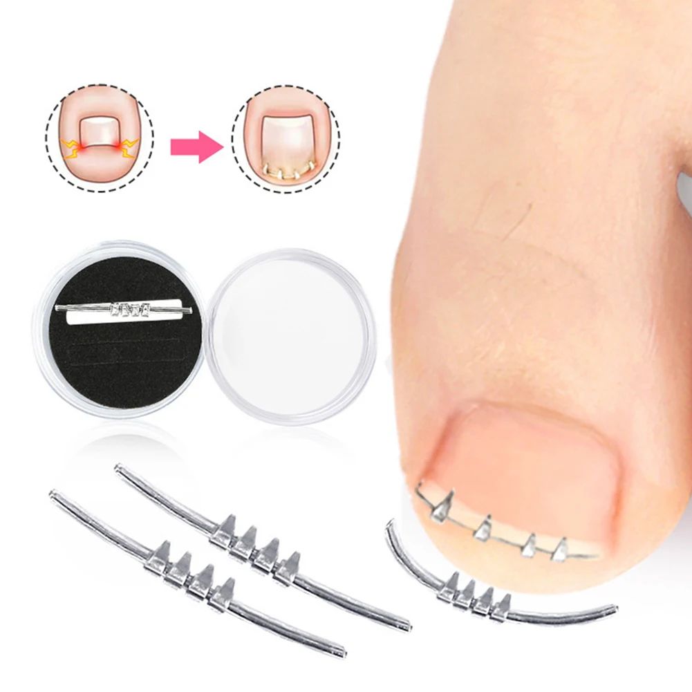 Ingrown Toenail Corrector Tool Precision Nail Lifting Clamp