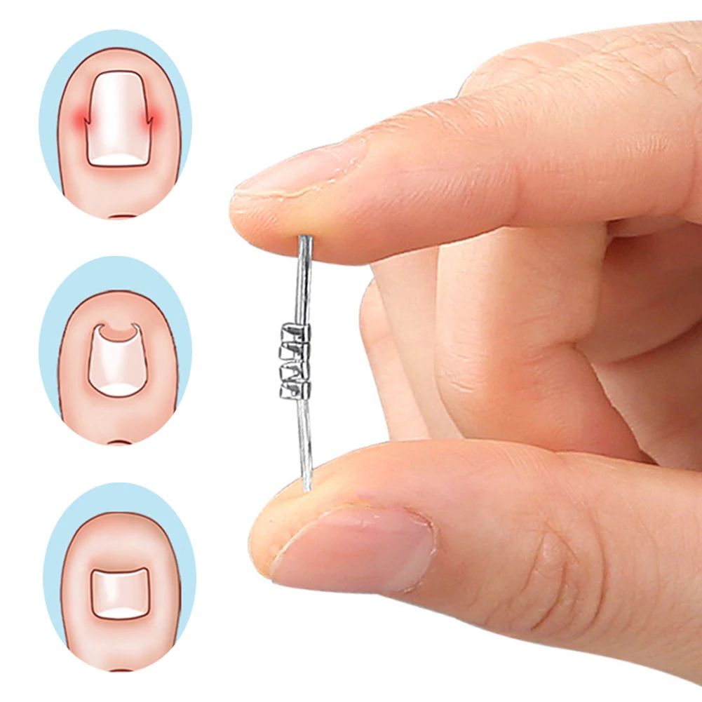 Ingrown Toenail Corrector Tool Precision Nail Lifting Clamp