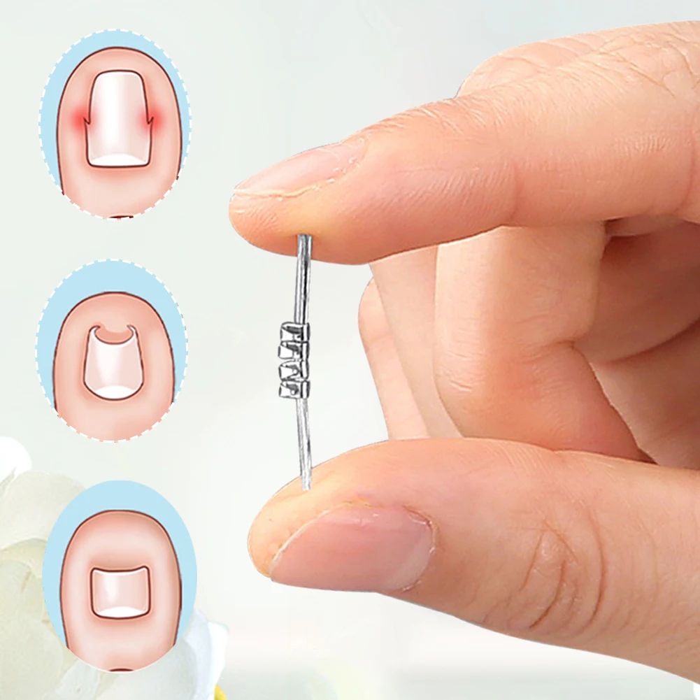 Ingrown Toenail Corrector Tool Precision Nail Lifting Clamp