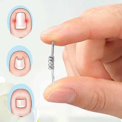 Ingrown Toenail Corrector Tool Precision Nail Lifting Clamp