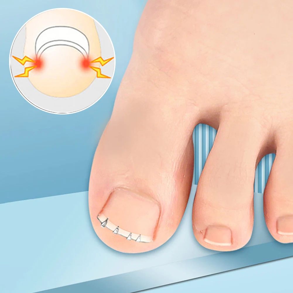 Ingrown Toenail Corrector Tool Precision Nail Lifting Clamp