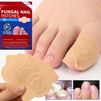 Advanced Nail Fungus Treatment Patches for Ingrown Toenail Repair & Healthy Nail Recovery