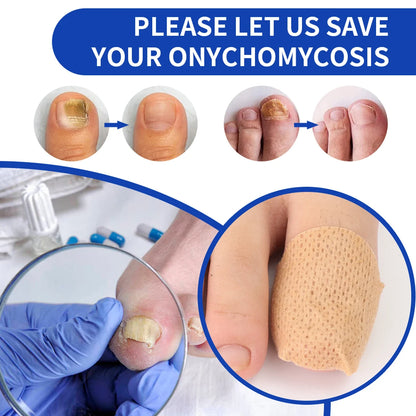 Advanced Nail Fungus Treatment Patches for Ingrown Toenail Repair & Healthy Nail Recovery