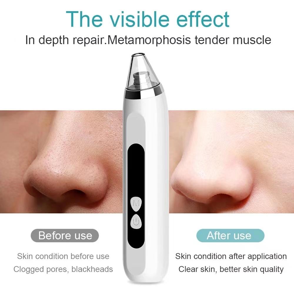 Blackhead Remover Vacuum Deep Pore Cleaner with 3 Suction Levels and 3 Facial Cleaning Heads